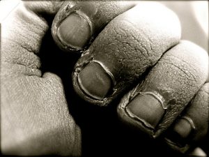 Laborious work can lead to calloused, cracked skin- no cream can fix this! (Image:Megyarsh/flickr)