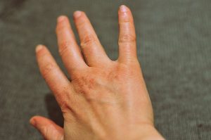 Dry, cracked hands feel and look old (Image:fred_v/flickr)