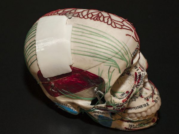 Mock 3-D printed skull plate (cranioplasty) – the real medical device is used for patients who need a portion of their skull replaced. (Image: FDA via wikimedia / CC0 1.0)