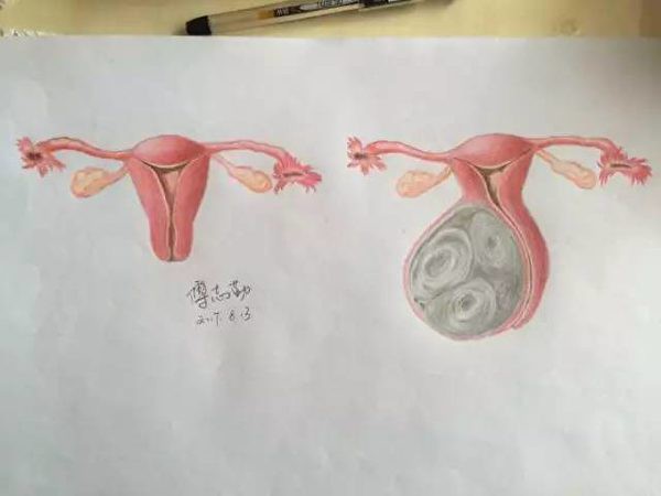 Fu Zhiqin for colleagues to draw the normal uterus (left) and suffering from tumor uterine (right) comparison chart. (Image: Fu Zhiqin/ntdtv)