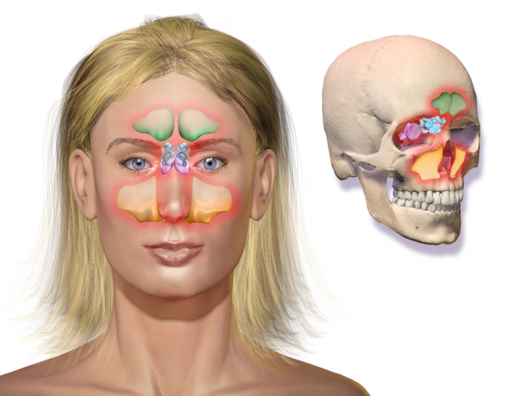 It is understood that the accumulation of dust and pathogens, like viruses or bacteria, over time can lead to the chronic symptoms associated with sinusitis. 