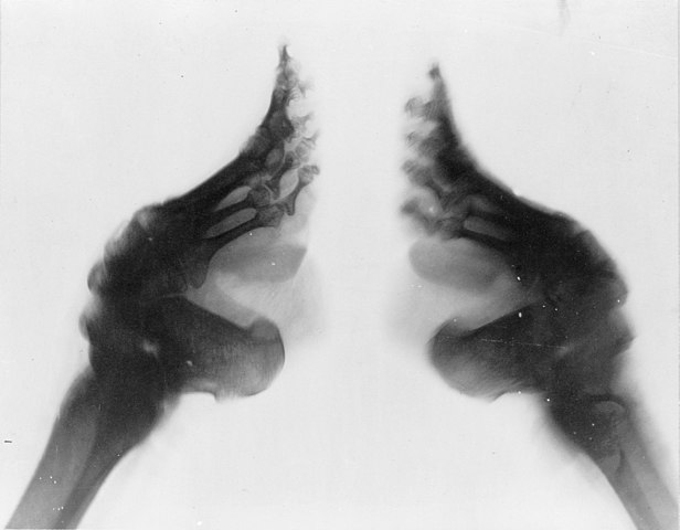 foot binding