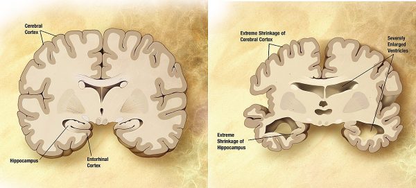 Comparison of a normal aged brain (left) and the brain of a person with Alzheimer's (right). (Image: wikimedia / CC0 1.0)