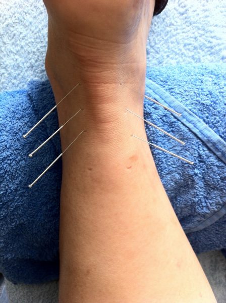 Acupuncture works exceptionally well for traumatic injuries because it helps increase blood circulation. (Image: pixabay / CC0 1.0)