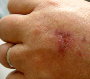 Symptoms include painful blisters, which become darkly pigmented and can cause scars. (Image: Lamiot via flickr CC BY-SA 3.0)