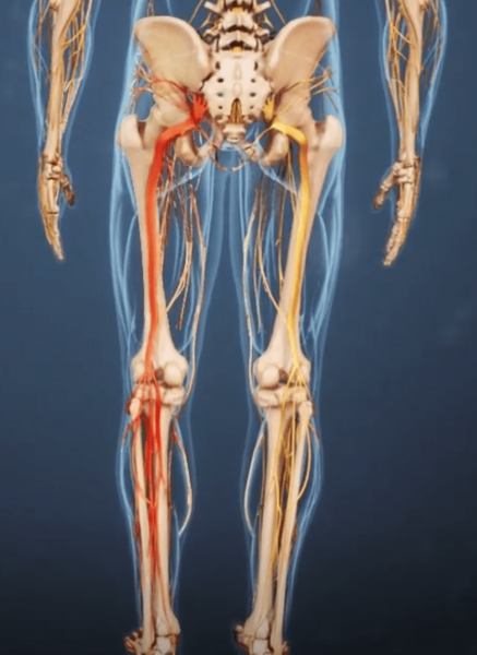 Sciatica is a medical condition characterized by sharp pain and numbness radiating down the sciatic nerve, from the lower back to the buttocks and down the leg. (Image: spine-health.com)