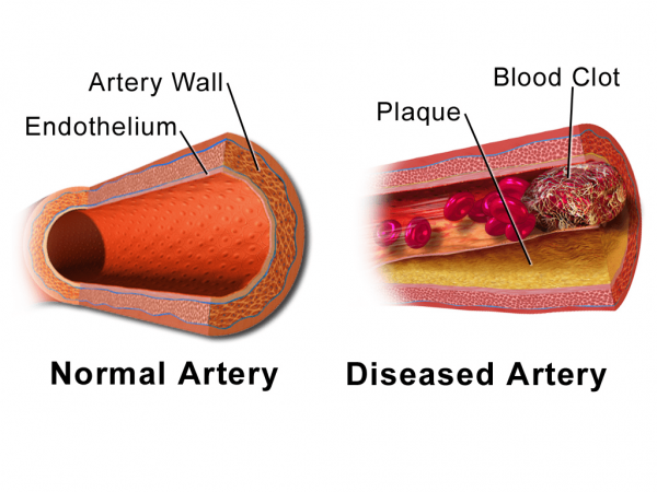Illustration comparing normal artery vs diseased artery with a blood clot. (Image: Bruce Blaus via wikimedia CC BY 3.0)