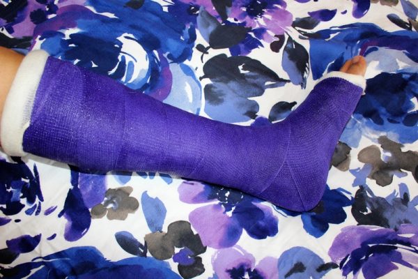 Ankle sprains can be serious if there is a fractured bone.