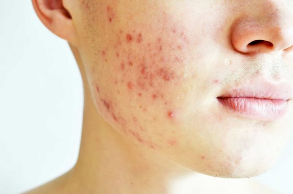 acne_cheeks