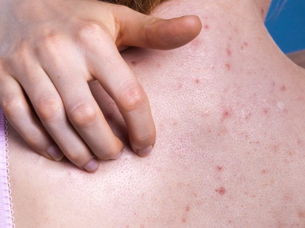 back_acne