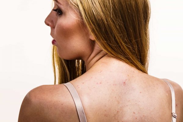 There are so many things you can do to treat and prevent bacne; when you adopt a few of these practices into your daily life, you'll be able to get over the hump and begin to win the war.