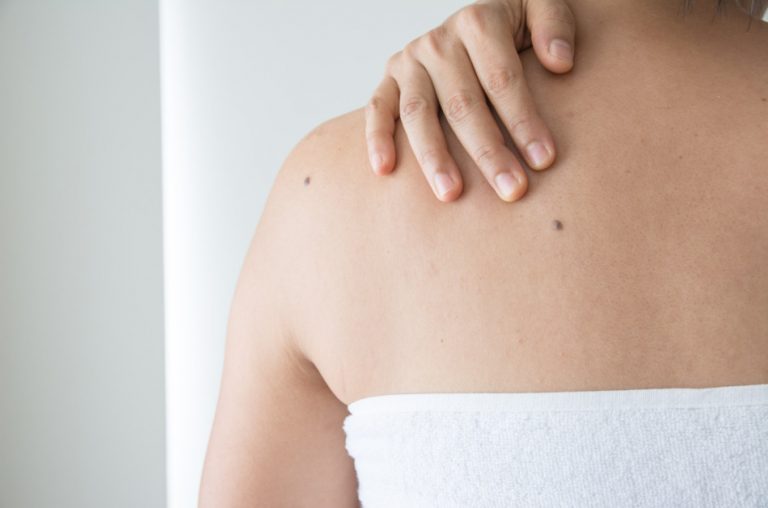 Shot of a woman with her back to the camera wrapped in a white towel and showing moles on her skin.