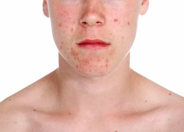 Severe acne on the face.