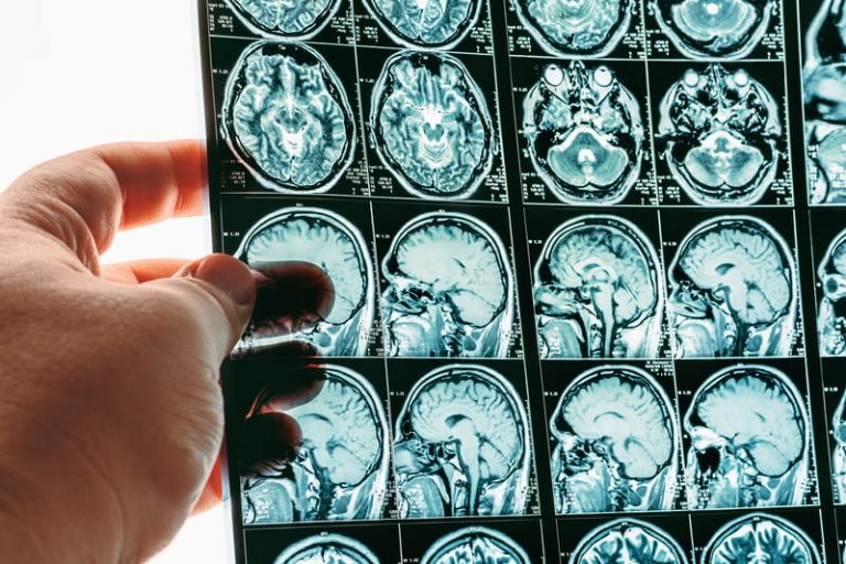 Male hand holding an MRI scan of the brain.