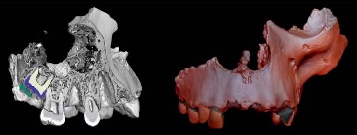 Jaw bone of the human fossil species Homo antecessor from Spain. Left: micro-CT scan with a cutting plane to visualize the inner structures, bone, and teeth; right: 3D reconstruction based on the high-resolution micro-CT images.