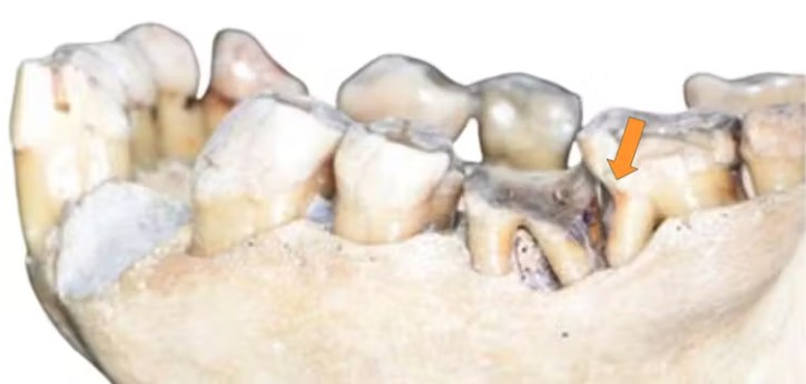 Orangutan (Pongo pygmaeus) with a ‘toothpick groove’ on the lower left second molar (specimen FMNH 19026; Field Museum Chicago).