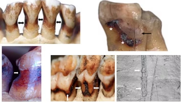 Different types of root lesions found in wild primates. Including acidic erosion (top left), and grooves with similar characteristics to tooth-picking grooves in fossil human samples.