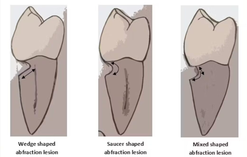 An illustration of what abfraction lesions look like in modern human teeth.