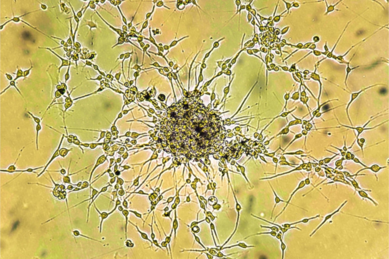 Malignant brain tumor cells as seen under a microscope.