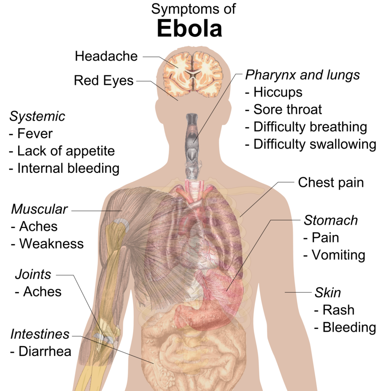 Signs and symptoms of Ebola.