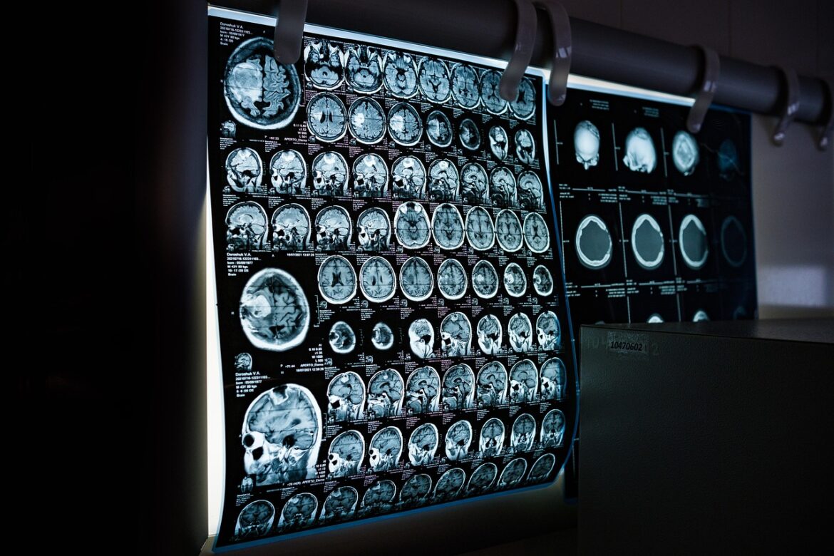 Cross-section views of a brain.